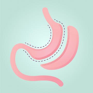 Sleeve Gastrectomy