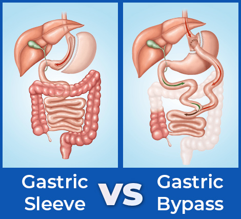 gastric bypass vs gastric sleeve illustration