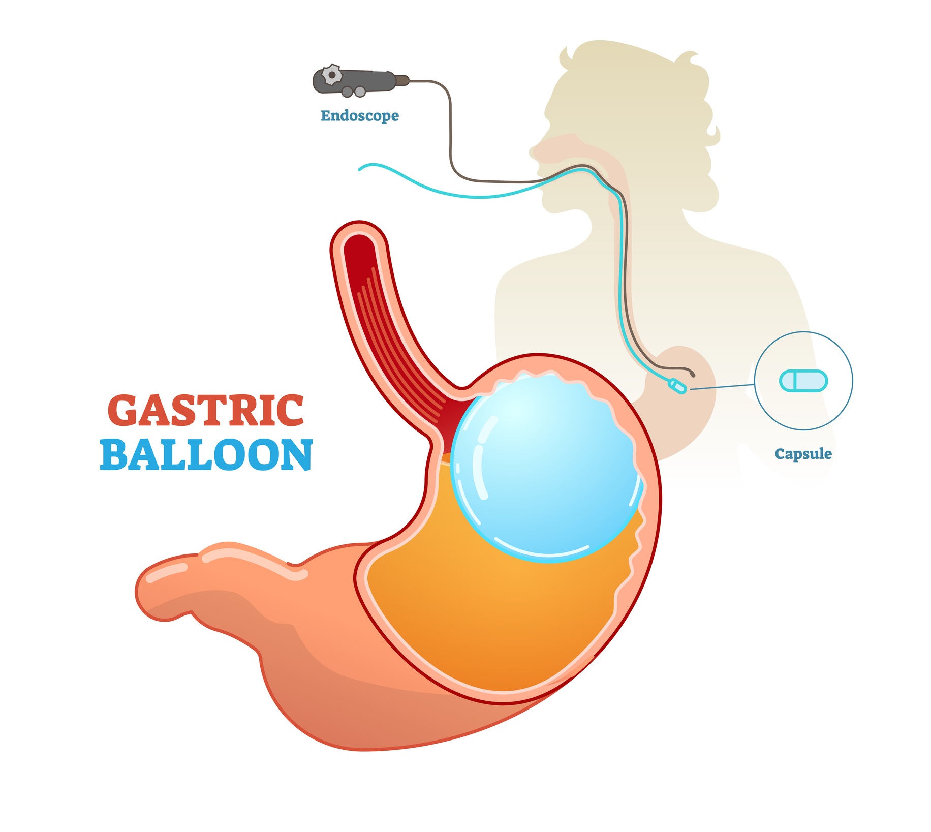 Gastric balloon medical procedure concept diagram, vector illustration. Weight loss and obesity treatment.
