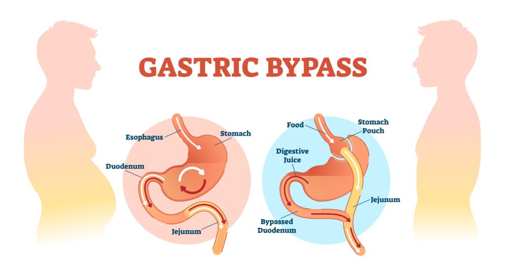 Gastric bypass surgery diagram showing before image with stomach and an after-surgery image with the bypass.