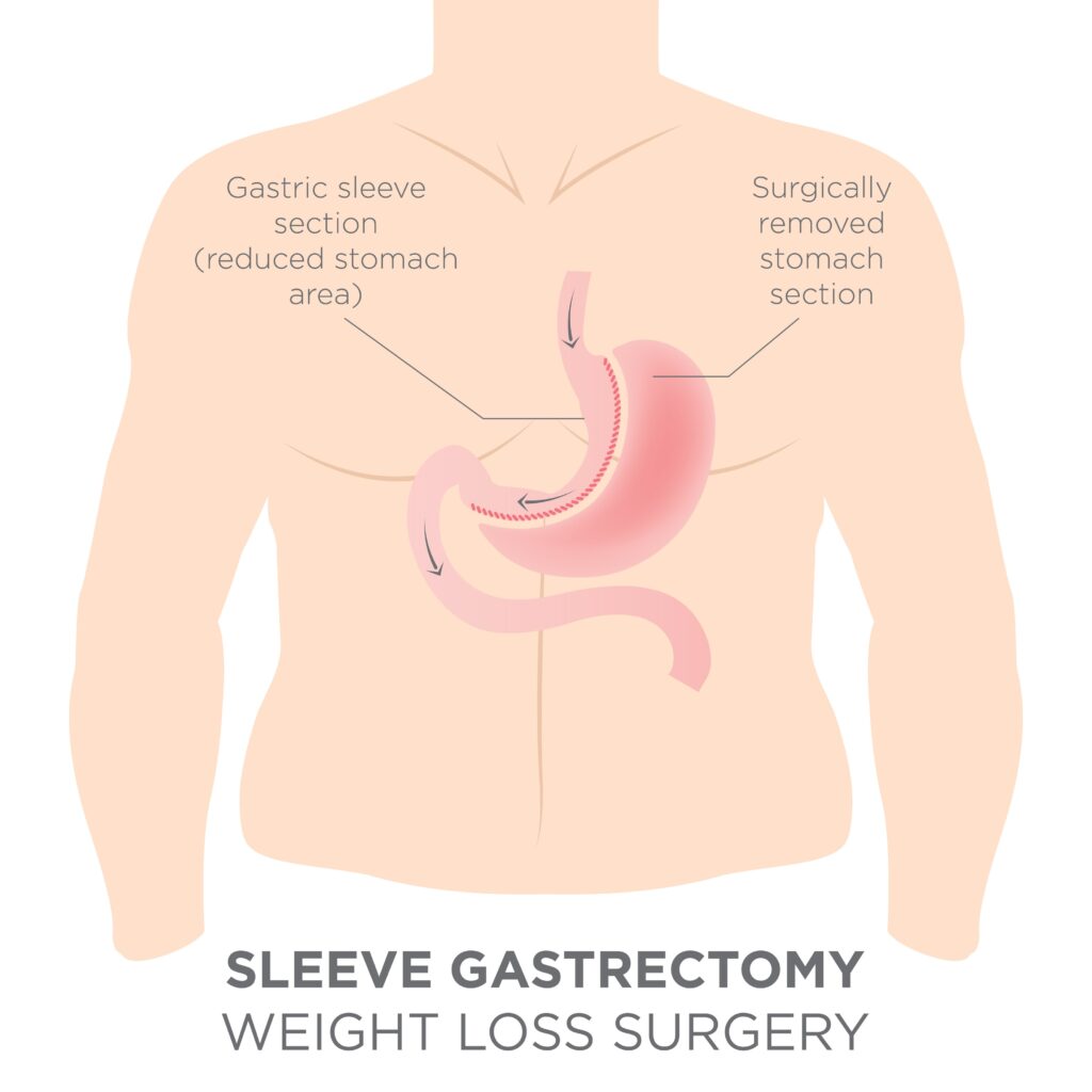 Diagram of person from waist up showing an illustration of a sleeve gastrectomy weight loss surgery.