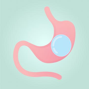 Intragastric Balloon